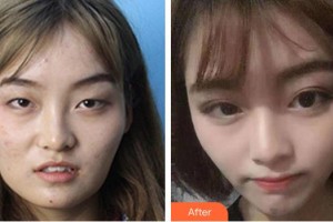 普寧市人民醫(yī)院眼科余杰克整形價(jià)格表附眼部綜合案例展示