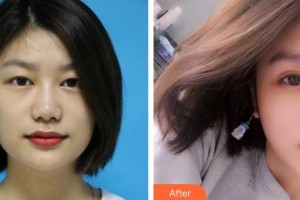 廣空后勤醫(yī)院整形美容中心黃社棟整形價格表附眼部綜合案例展示