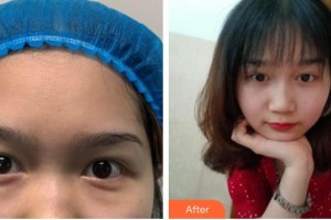 廣空后勤醫(yī)院整形美容中心張主任整形價格表附內(nèi)切祛眼袋案例展示