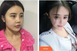 廣空后勤醫(yī)院整形美容中心賀醫(yī)生整形價格表附眼部綜合案例展示