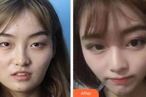 廣空后勤醫(yī)院整形美容中心冼紀(jì)雯整形價格表附眼部綜合案例展示
