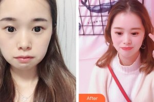 連云港第一人民醫(yī)院燒傷整形科丁祥生整形價(jià)格表附眼部綜合案例展示