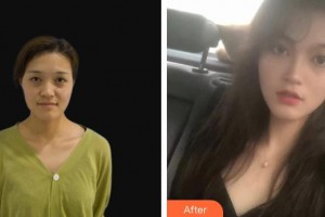 連云港徐楊醫(yī)療美容門診部徐楊整形價(jià)格表附眼部綜合案例展示