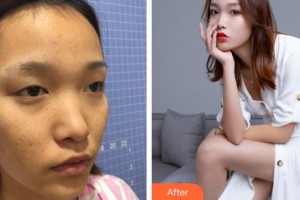 連云港徐楊醫(yī)療美容門診部吳紅波整形價(jià)格表附眶隔脂肪釋放案例展示