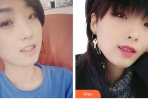 西昌口腔醫(yī)院李華君整形價格表附金屬托槽矯正案例展示