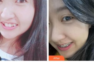 西昌口腔醫(yī)院葉青整形價格表附金屬托槽矯正案例展示