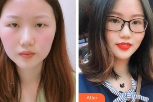 南昌大學(xué)附屬眼科醫(yī)院張旭整形價(jià)格表附切開(kāi)雙眼皮案例展示