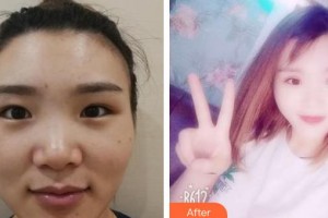 南昌大學(xué)附屬眼科醫(yī)院程玲整形價(jià)格表附切開雙眼皮案例展示