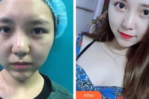 南昌大學(xué)附屬眼科醫(yī)院楊璐整形價(jià)格表附切開雙眼皮案例展示