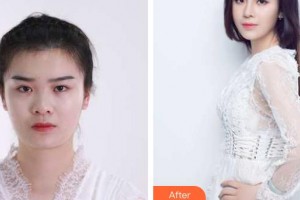 南昌大學(xué)附屬眼科醫(yī)院徐柒華整形價(jià)格表附埋線雙眼皮案例展示