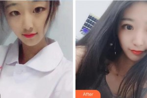 南昌大學(xué)附屬眼科醫(yī)院魯宇容整形價(jià)格表附眼部綜合案例展示