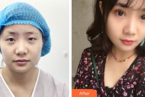 南昌大學(xué)附屬眼科醫(yī)院黃傳華整形價(jià)格表附眼部綜合案例展示