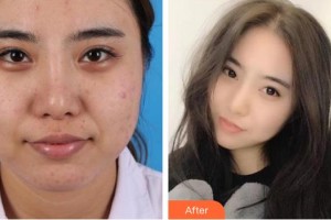 南昌大學(xué)附屬眼科醫(yī)院黃琴整形價(jià)格表附眼部修復(fù)案例展示