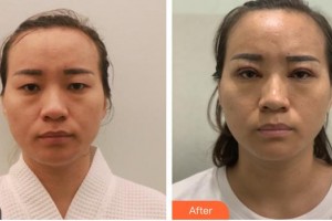 南昌大學(xué)附屬眼科醫(yī)院劉莉莉整形價(jià)格表附開內(nèi)眼角案例展示