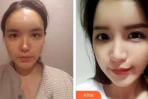 南昌大學(xué)附屬眼科醫(yī)院易昀敏整形價(jià)格表附眼部綜合案例展示