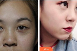 南昌愛(ài)爾眼科醫(yī)院朱加貴整形價(jià)格表附定點(diǎn)雙眼皮案例展示