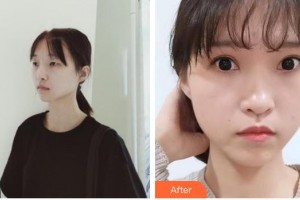 南昌愛(ài)爾眼科醫(yī)院易文殊整形價(jià)格表附眼部綜合案例展示