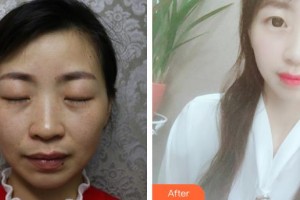 南昌愛(ài)爾眼科醫(yī)院盧恒松整形價(jià)格表附眼部綜合案例展示