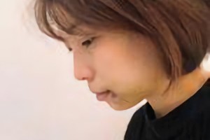 杭州時(shí)光醫(yī)療美容醫(yī)院河?xùn)|鎬磨骨怎么樣?附術(shù)后果圖