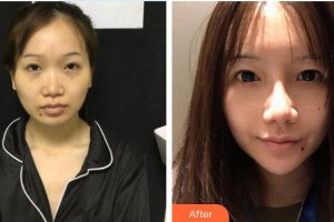 東南大學(xué)附屬中大醫(yī)院整形外科熊猛整形價(jià)格表附鼻部綜合案例展示
