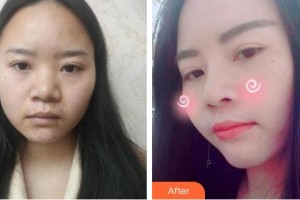 東南大學(xué)附屬中大醫(yī)院整形外科王磊整形價(jià)格表附鼻部綜合案例展示