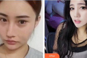 皖南醫(yī)學(xué)院弋磯山醫(yī)院整形外科潘勇整形價(jià)格表附鼻部綜合】案例展示