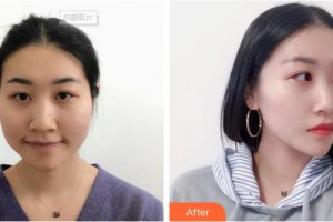 雞西市人民醫(yī)院燒傷整形科孟杰整形價(jià)格表附鼻部綜合案例展示