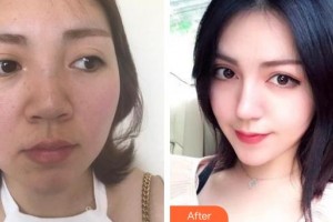 雞西王醫(yī)生整形外科門(mén)診部徐瑞宏整形價(jià)格表附硅膠隆鼻案例展示