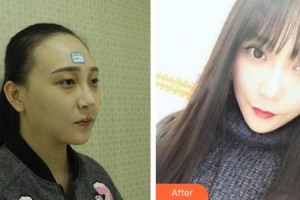 咸陽(yáng)華爾醫(yī)療美容門診部張秦鵬整形價(jià)格表附埋線雙眼皮案例展示