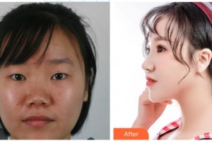 咸陽(yáng)華爾醫(yī)療美容門診部史娟娟整形價(jià)格表附眼部綜合案例展示