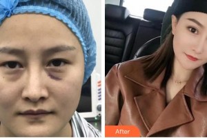 咸陽(yáng)愛爾眼科醫(yī)院周善文整形價(jià)格表附切開雙眼皮案例展示