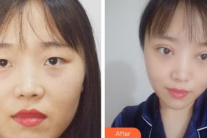咸陽(yáng)愛爾眼科醫(yī)院劉雪芳整形價(jià)格表附切開雙眼皮案例展示