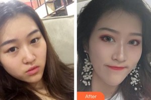 咸陽(yáng)愛爾眼科醫(yī)院陳小瑾整形價(jià)格表附切開雙眼皮案例展示