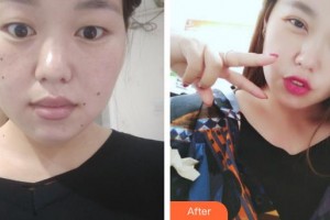 咸陽(yáng)市第一人民醫(yī)院眼科醫(yī)院許淑云整形價(jià)格表附眼部綜合案例展示