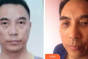 咸陽(yáng)市第一人民醫(yī)院眼科醫(yī)院蒲曉莉整形價(jià)格表附激光去眼袋案例展示