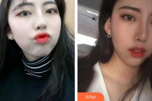 咸陽(yáng)市第一人民醫(yī)院眼科醫(yī)院董永孝整形價(jià)格表附眼部綜合案例展示