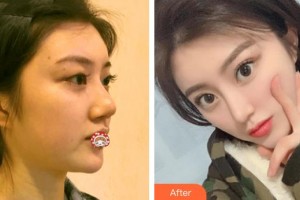 咸陽(yáng)市第一人民醫(yī)院眼科醫(yī)院魚(yú)喆整形價(jià)格表附切開(kāi)雙眼皮案例展示