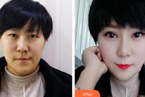 咸陽(yáng)市第一人民醫(yī)院眼科醫(yī)院劉甜整形價(jià)格表附眼部修復(fù)案例展示