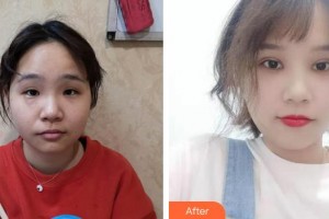 咸陽(yáng)市第一人民醫(yī)院眼科醫(yī)院趙金整形價(jià)格表附眼部手術(shù)案例展示