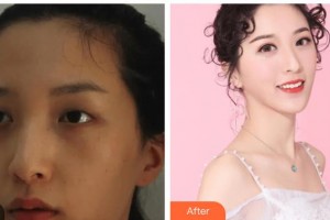 咸陽(yáng)市第一人民醫(yī)院眼科醫(yī)院裴瑞整形價(jià)格表附切開(kāi)雙眼皮案例展示