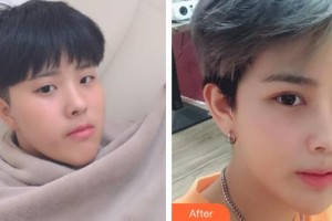 乳山新視力眼科醫(yī)院劉風(fēng)林整形價(jià)格表附切開雙眼皮案例展示