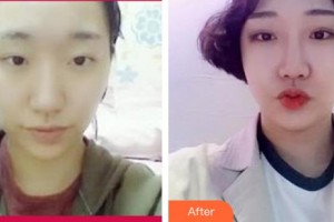 諸暨愛爾眼科醫(yī)院任遠(yuǎn)望整形價(jià)格表附切開雙眼皮案例展示