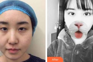 諸暨愛爾眼科醫(yī)院趙士英整形價(jià)格表附切開雙眼皮案例展示