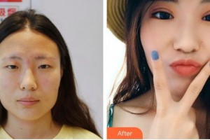 諸暨愛爾眼科醫(yī)院許如安整形價(jià)格表附切開雙眼皮案例展示