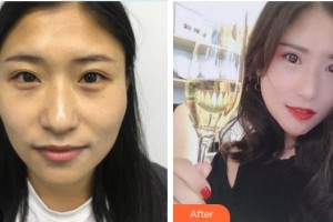 中南大學(xué)湘雅醫(yī)院整形美容中心譚軍整形價(jià)格表附黑臉娃娃案例展示