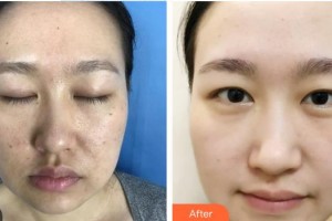 中南大學(xué)湘雅三醫(yī)院燒傷整形外科徐陽(yáng)成整形價(jià)格表附去痘印痘坑案例展示