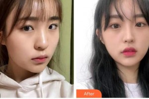 中南大學(xué)湘雅醫(yī)院整形美容中心楊興華整形價(jià)格表附水氧活膚案例展示