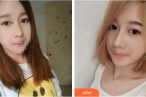 中南大學(xué)湘雅醫(yī)院整形美容中心祁敏整形價(jià)格表附清潔祛痘案例展示