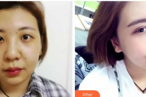 榮成眼科醫(yī)院郭文毅整形價(jià)格表附切開雙眼皮案例展示