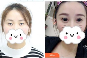 榮成眼科醫(yī)院原所鳳整形價(jià)格表附眼部綜合案例展示